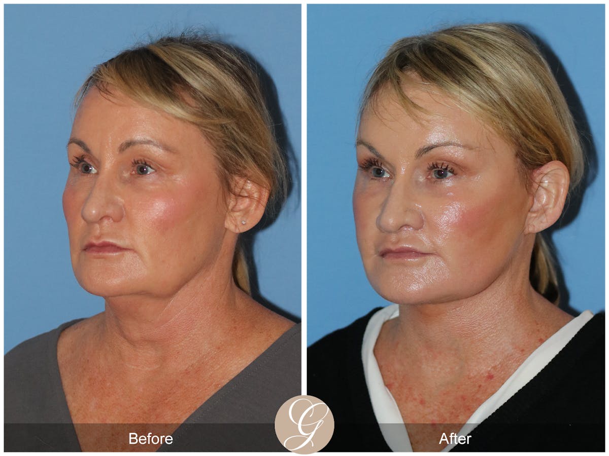 Neck Lift Before & After Gallery - Patient 185031 - Image 3