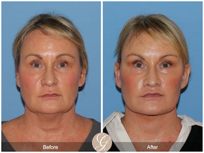Deep Plane Facelift Before & After Gallery - Patient 798918 - Image 1