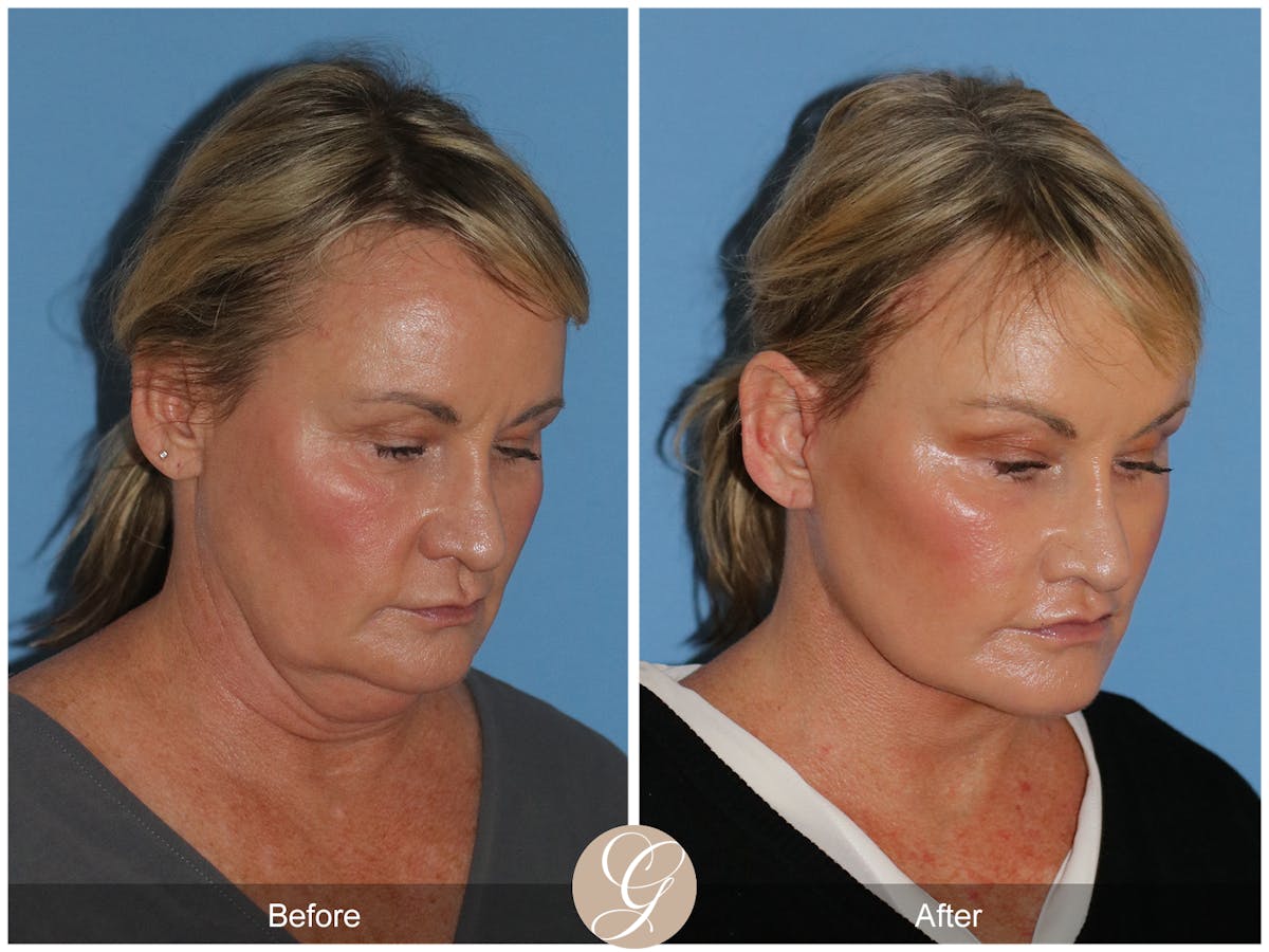 Neck Lift Before & After Gallery - Patient 185031 - Image 8