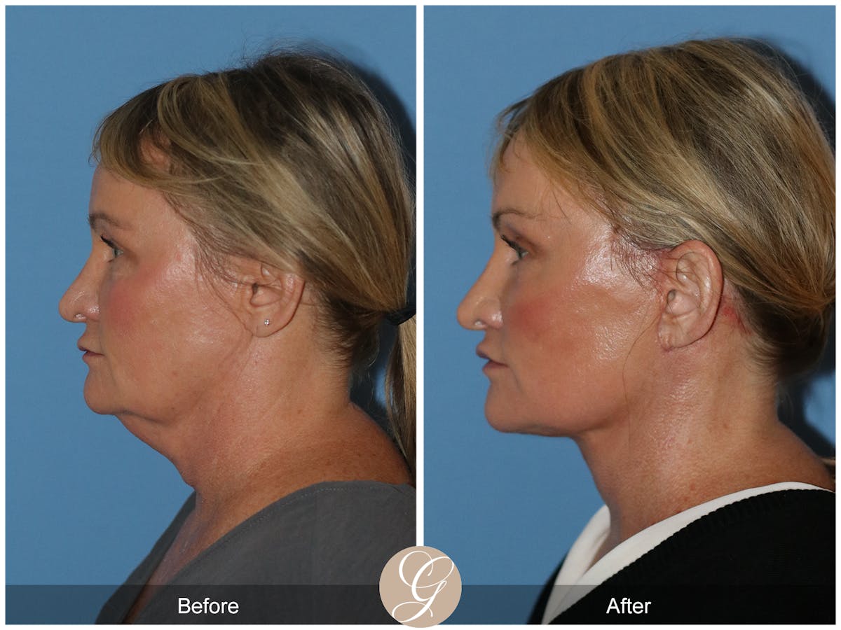 Neck Lift Before & After Gallery - Patient 185031 - Image 2