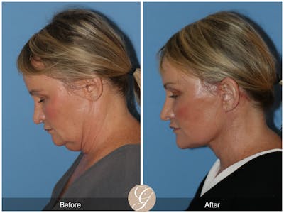 Neck Lift Before & After Gallery - Patient 185031 - Image 1