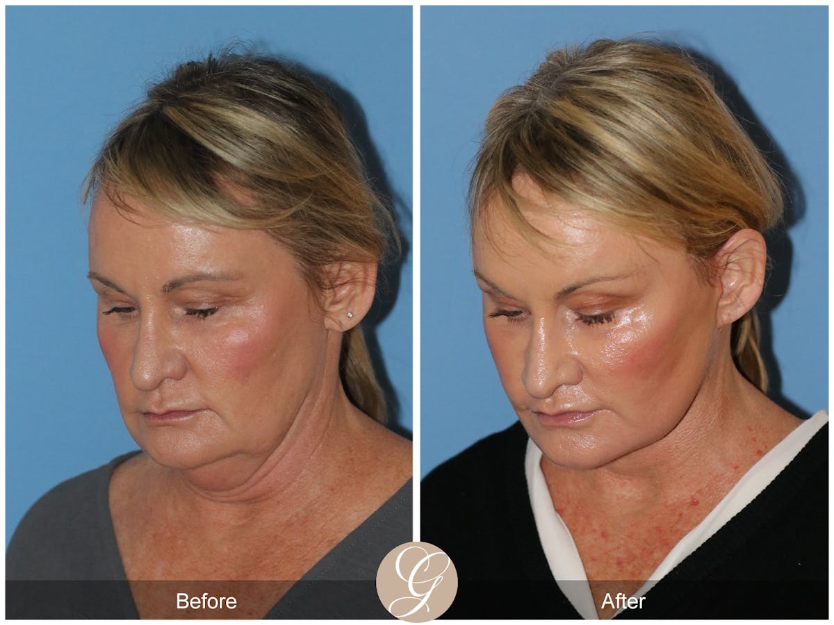 Neck Lift Before & After Gallery - Patient 185031 - Image 4