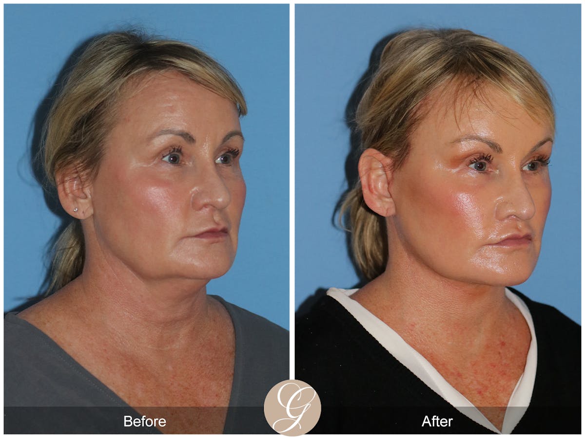 Neck Lift Before & After Gallery - Patient 185031 - Image 7