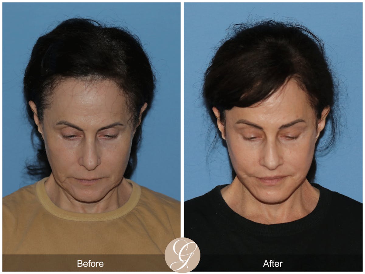 Neck Lift Before & After Gallery - Patient 279498 - Image 5