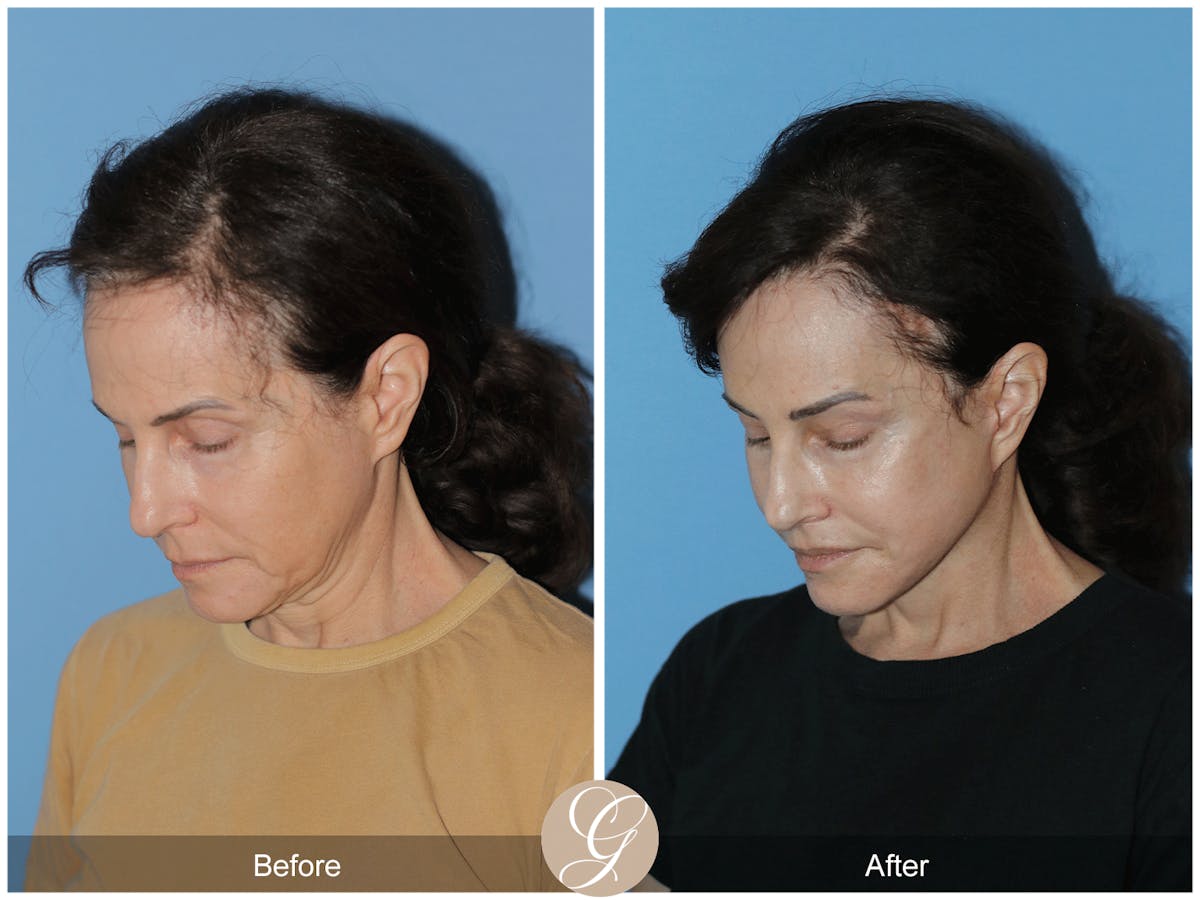 Neck Lift Before & After Gallery - Patient 279498 - Image 9