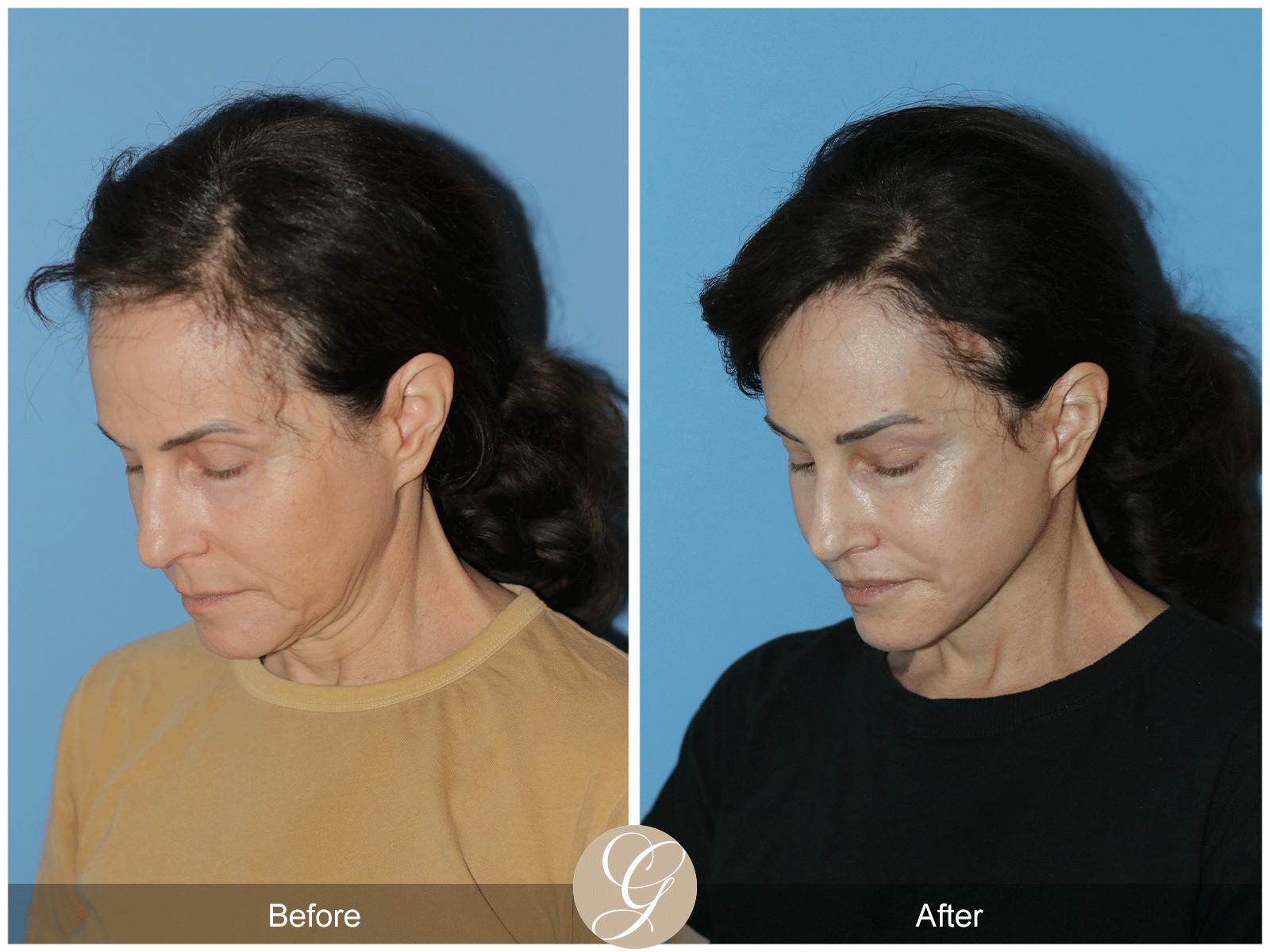 Deep Plane Facelift Before & After Gallery - Patient 402924 - Image 7