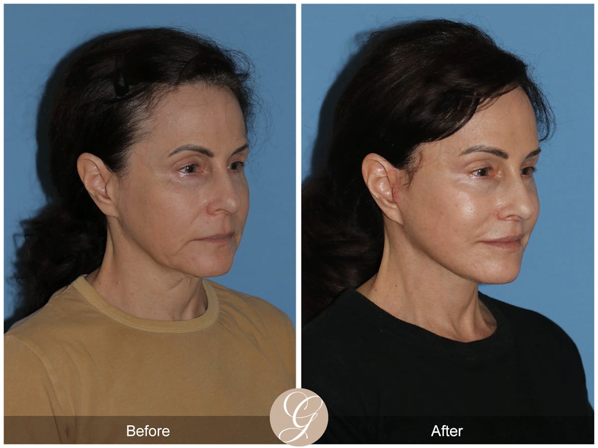 Neck Lift Before & After Gallery - Patient 279498 - Image 6