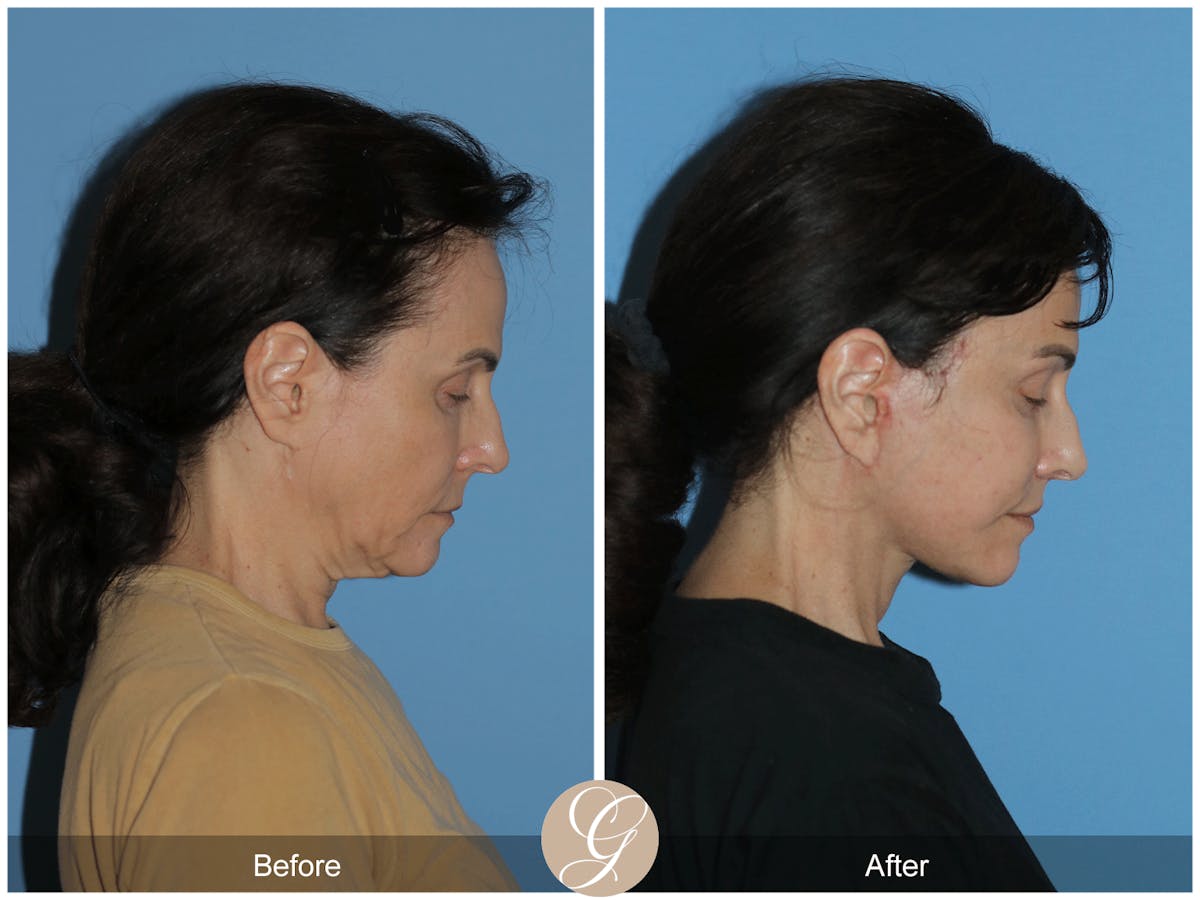 Neck Lift Before & After Gallery - Patient 279498 - Image 8