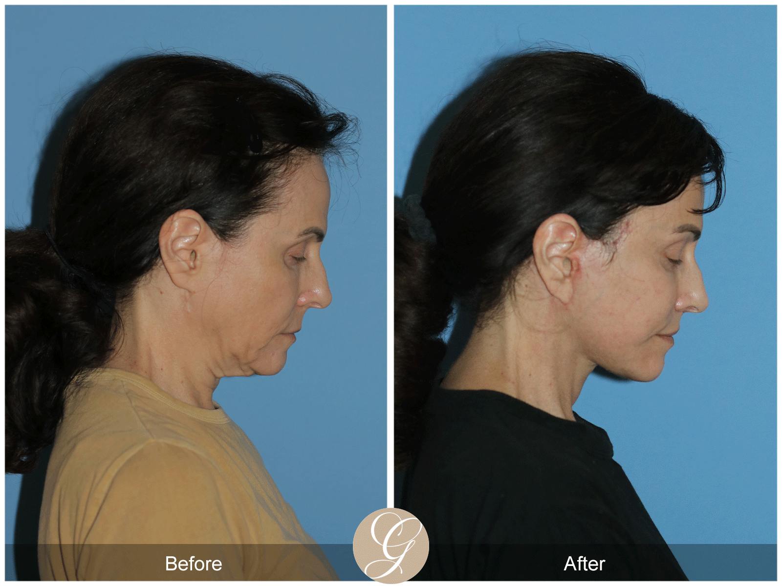 Deep Plane Facelift Before & After Gallery - Patient 402924 - Image 6