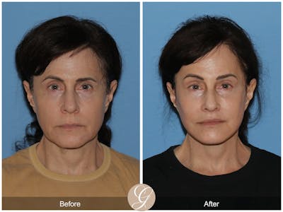 Deep Plane Facelift Before & After Gallery - Patient 402924 - Image 1