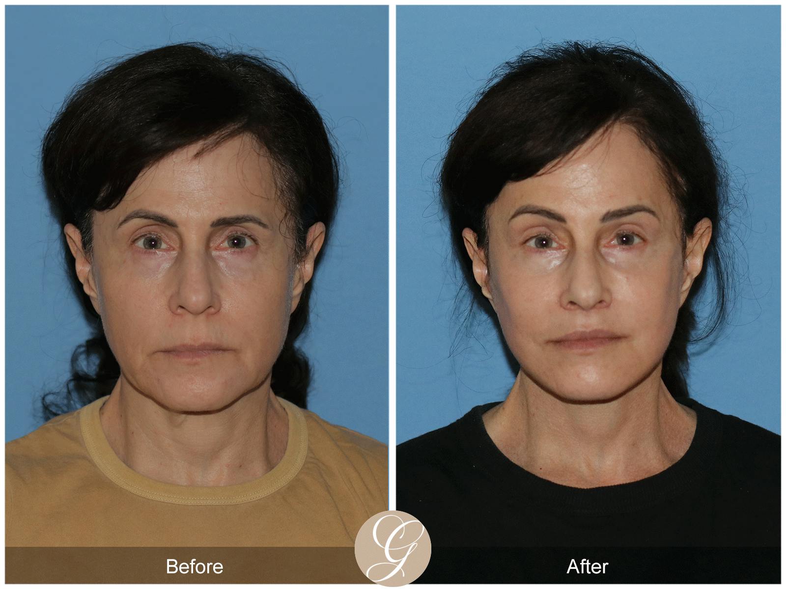 Deep Plane Facelift Before & After Gallery - Patient 402924 - Image 1