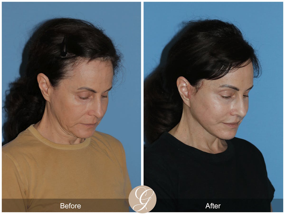 Neck Lift Before & After Gallery - Patient 279498 - Image 7