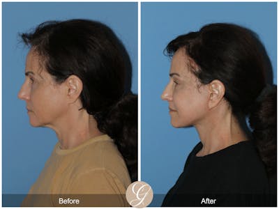 Neck Lift Before & After Gallery - Patient 279498 - Image 1