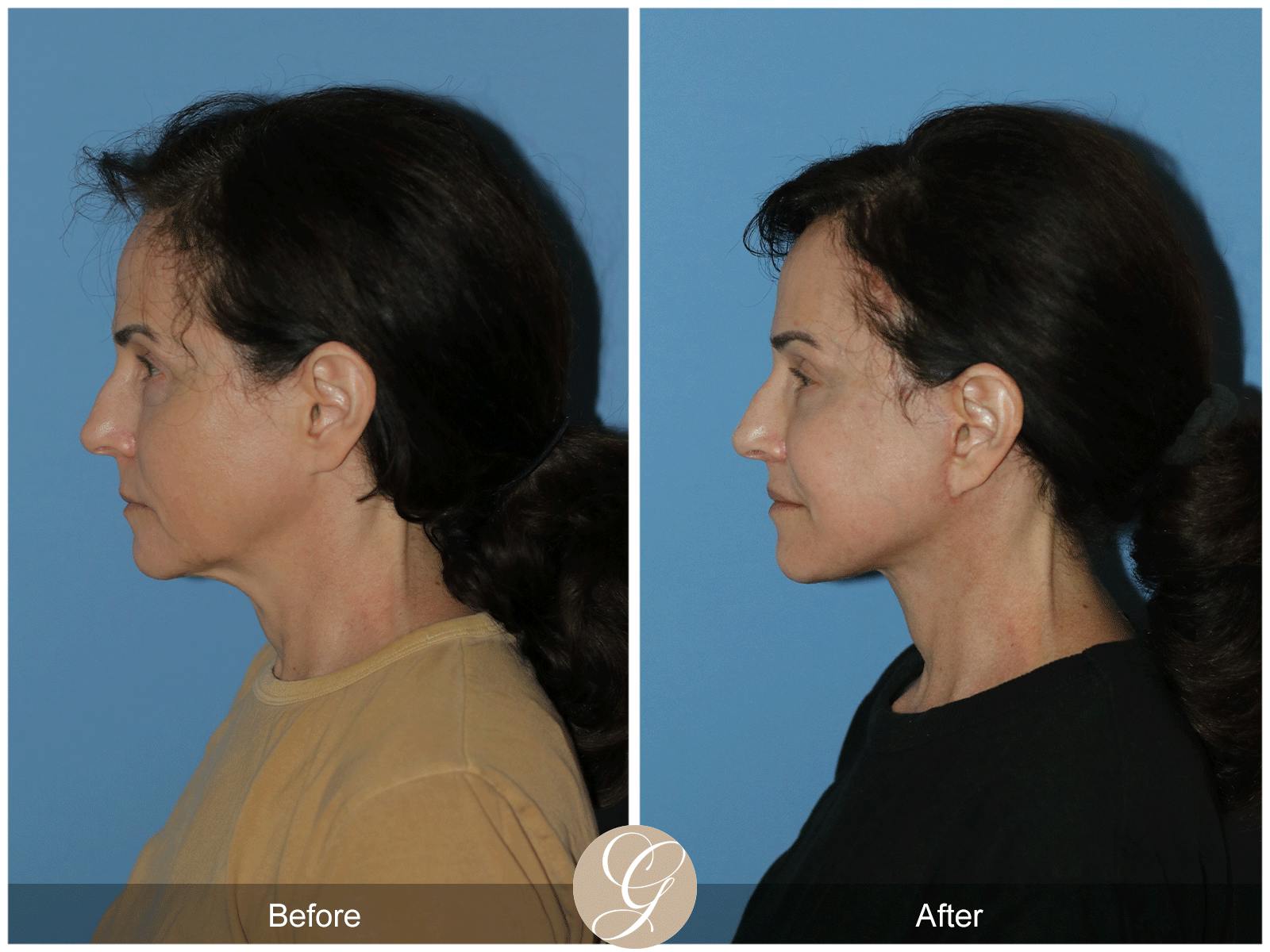 Deep Plane Facelift Before & After Gallery - Patient 402924 - Image 8