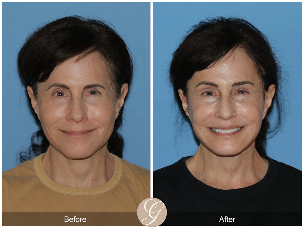 Neck Lift Before & After Gallery - Patient 279498 - Image 4