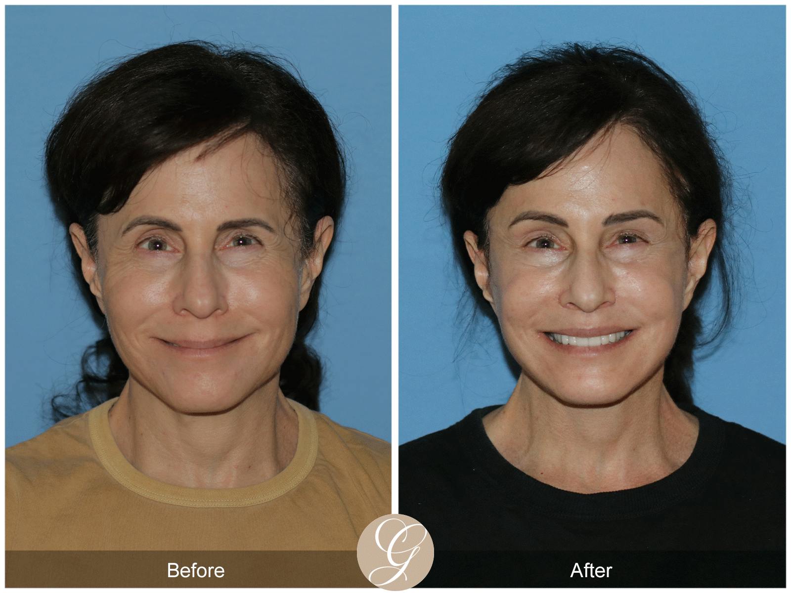 Deep Plane Facelift Before & After Gallery - Patient 402924 - Image 2