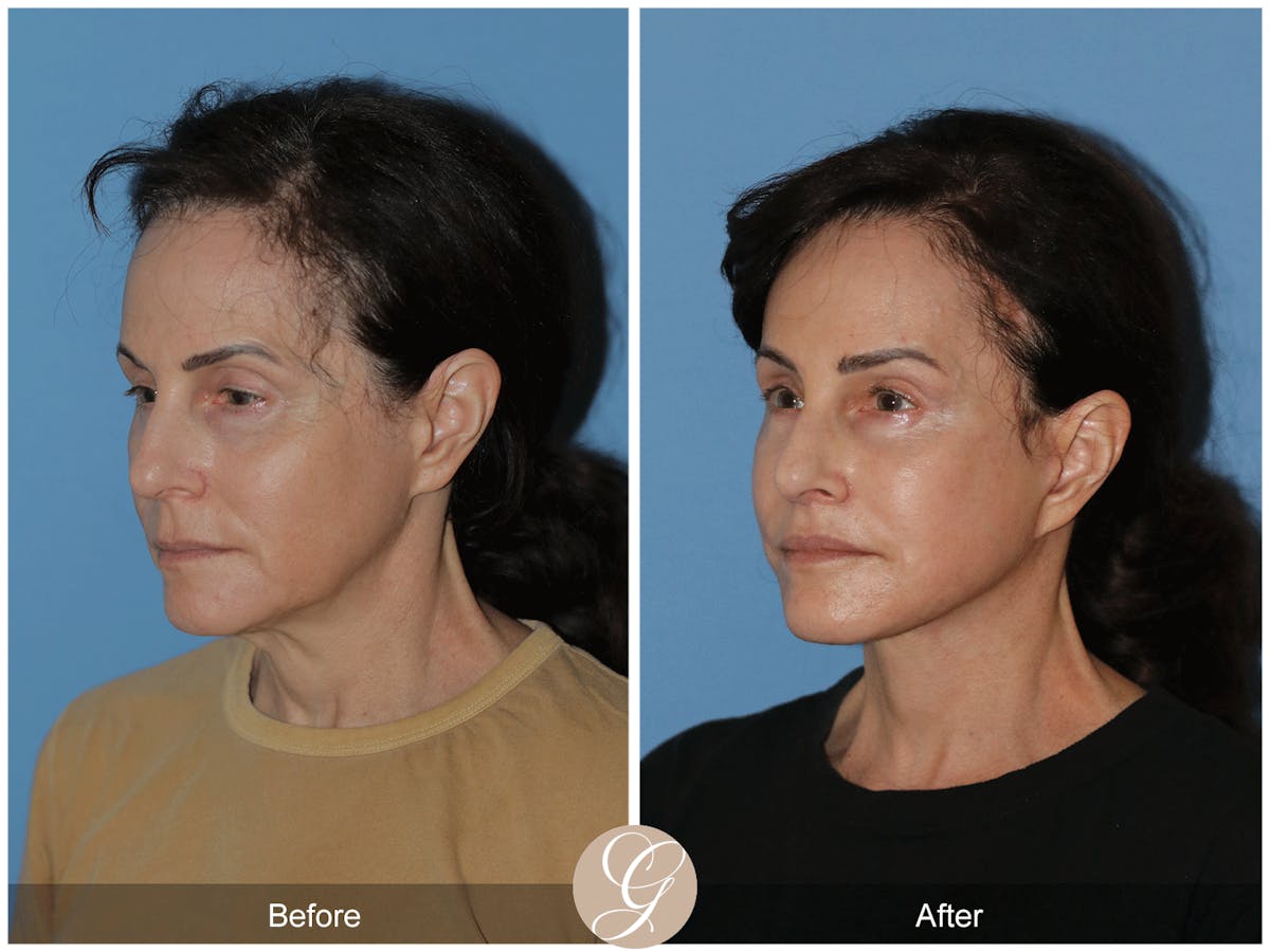Neck Lift Before & After Gallery - Patient 279498 - Image 2