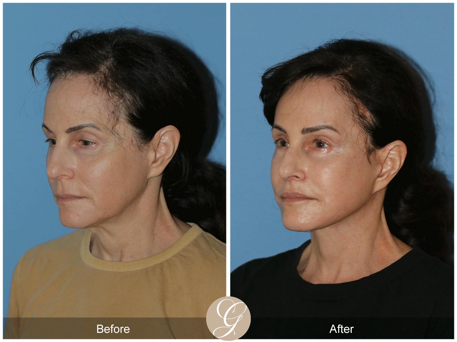 Deep Plane Facelift Before & After Gallery - Patient 402924 - Image 9