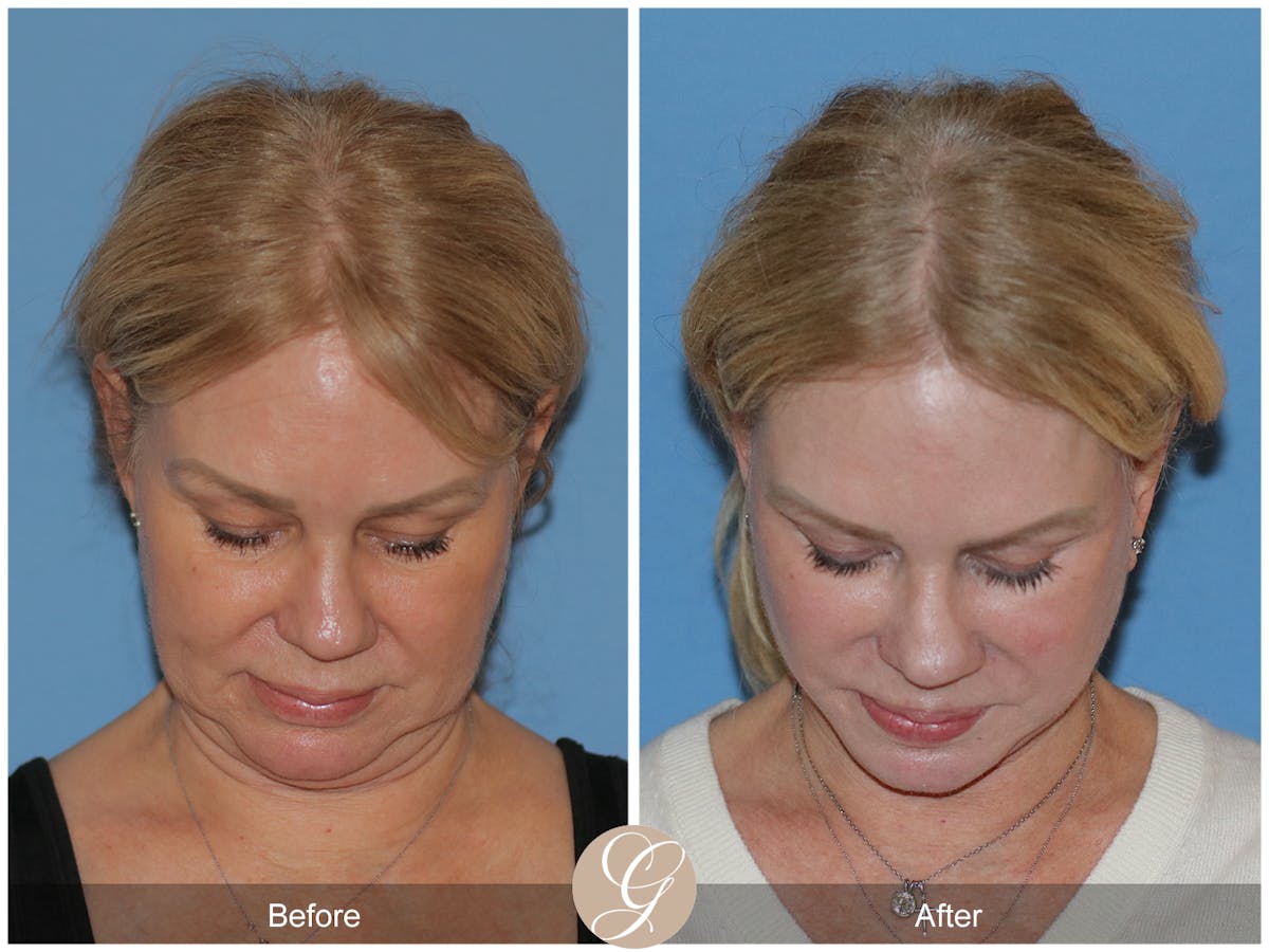 Neck Lift Before & After Gallery - Patient 301643 - Image 4