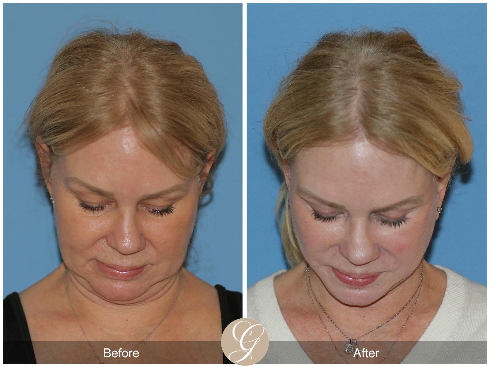 Deep Plane Facelift Before & After Gallery - Patient 301863 - Image 2
