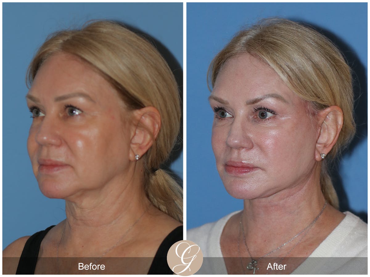 Neck Lift Before & After Gallery - Patient 301643 - Image 1