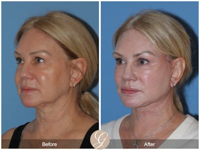 Neck Lift Before & After Gallery - Patient 301643 - Image 1