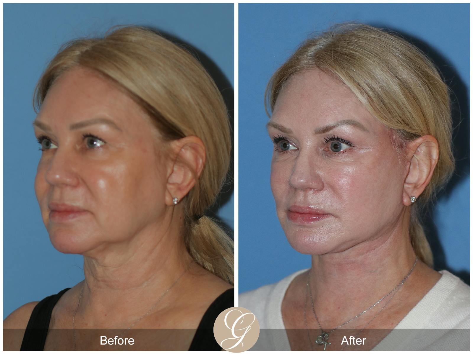 Deep Plane Facelift Before & After Gallery - Patient 301863 - Image 3