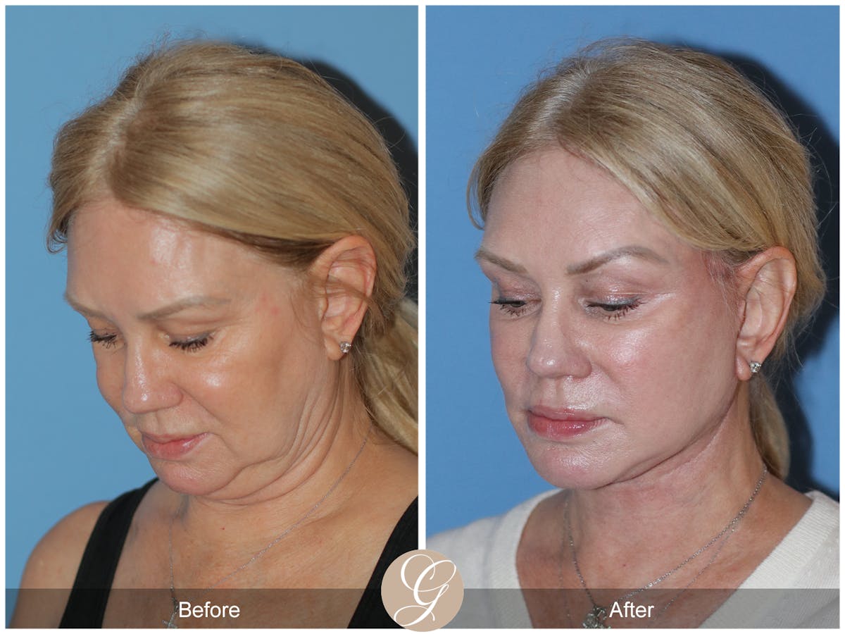 Neck Lift Before & After Gallery - Patient 301643 - Image 2