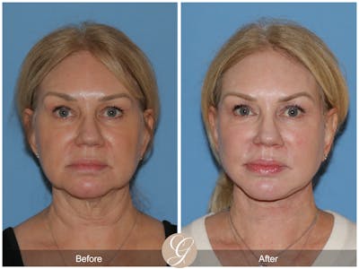 Facelift Patient Before and After