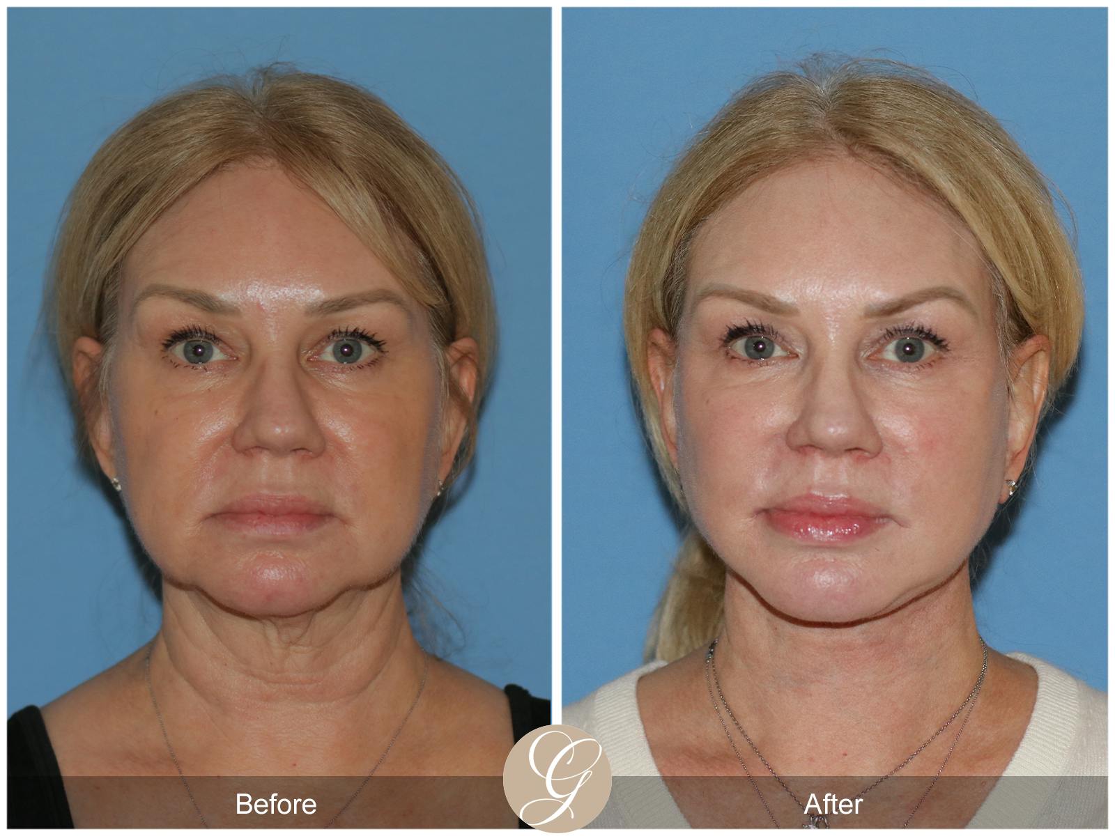 Facelift Patient Before and After
