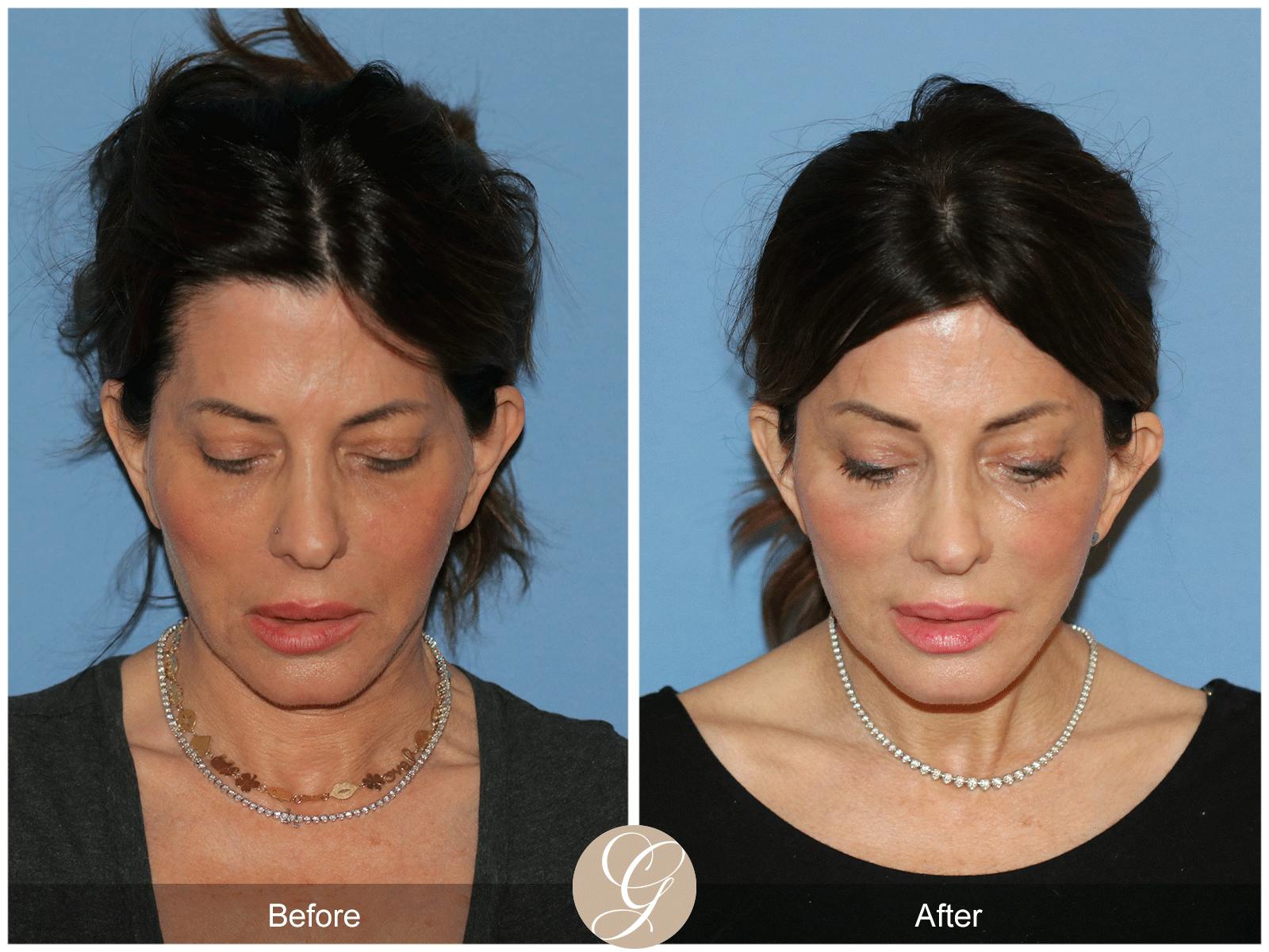 Deep Plane Facelift Before & After Gallery - Patient 364158 - Image 2