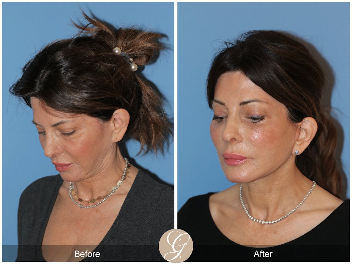 Neck Lift Before & After Gallery - Patient 940707 - Image 4