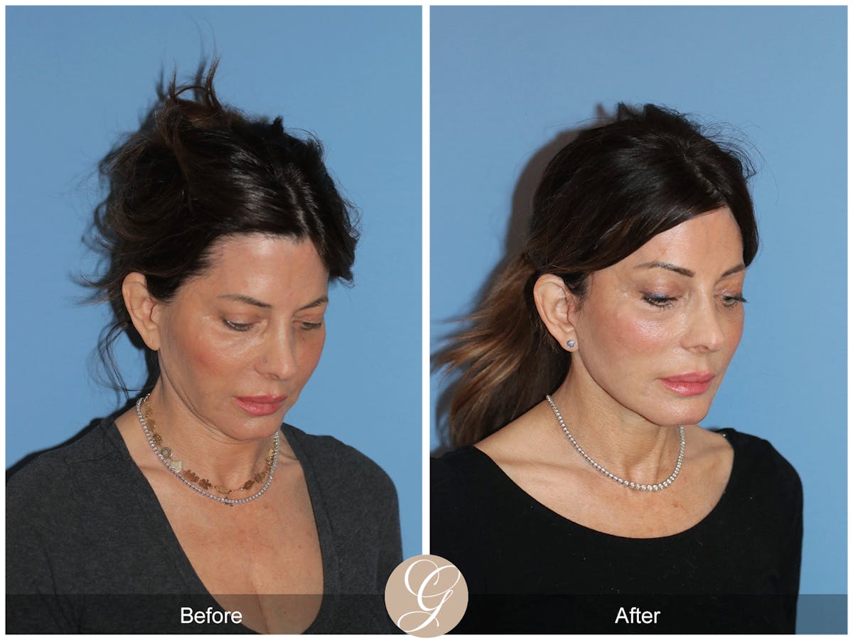 Neck Lift Before & After Gallery - Patient 940707 - Image 8