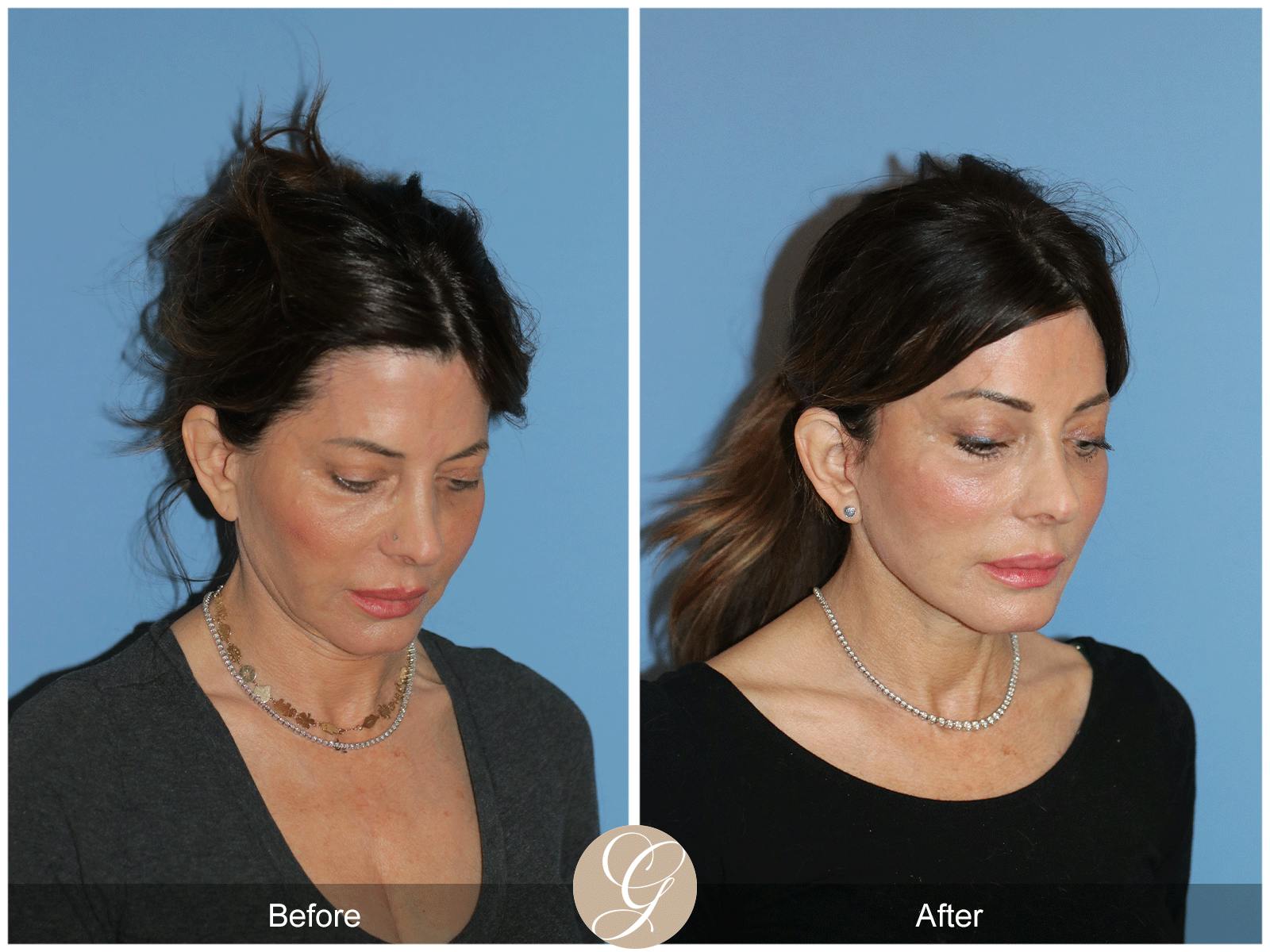 Deep Plane Facelift Before & After Gallery - Patient 364158 - Image 4