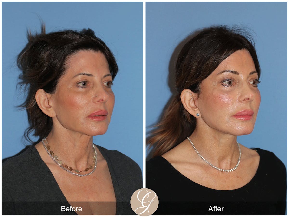 Neck Lift Before & After Gallery - Patient 940707 - Image 7