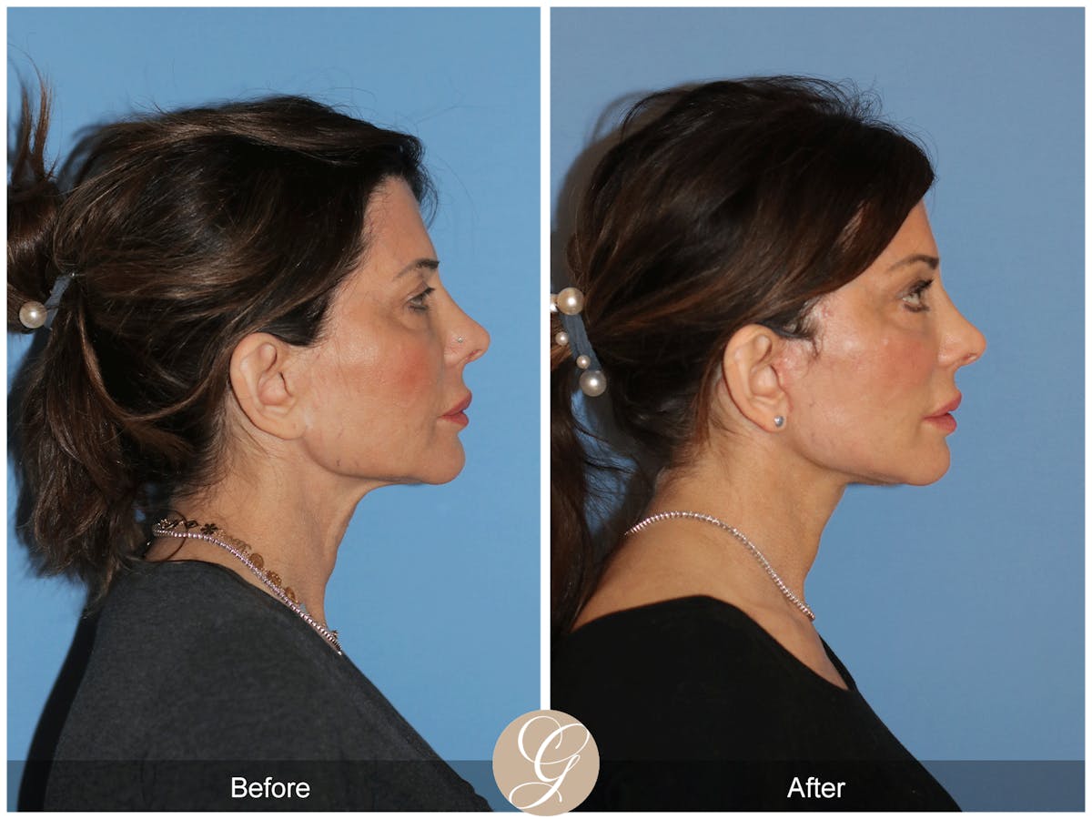 Neck Lift Before & After Gallery - Patient 940707 - Image 9