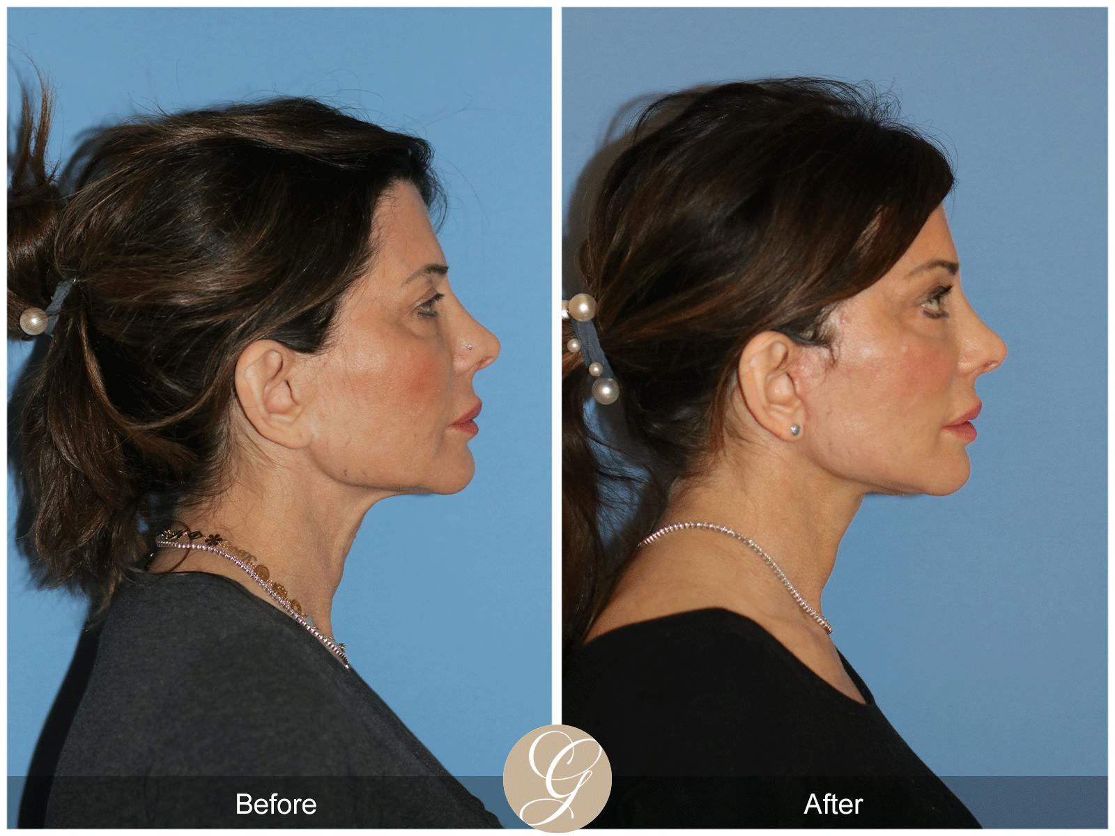 Deep Plane Facelift Before & After Gallery - Patient 364158 - Image 5