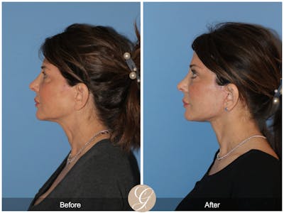 Neck Lift Before & After Gallery - Patient 940707 - Image 1