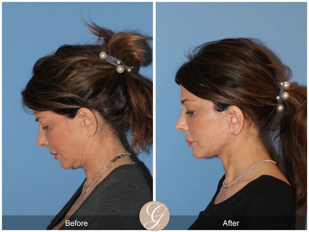 Neck Lift Before & After Gallery - Patient 940707 - Image 2