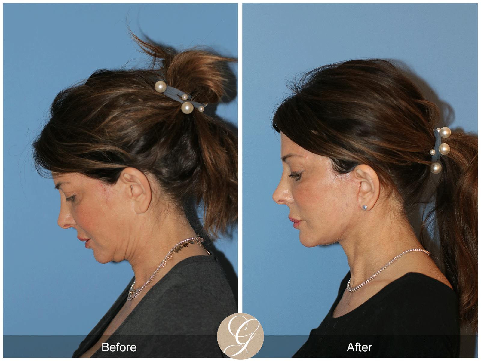Deep Plane Facelift Before & After Gallery - Patient 364158 - Image 9