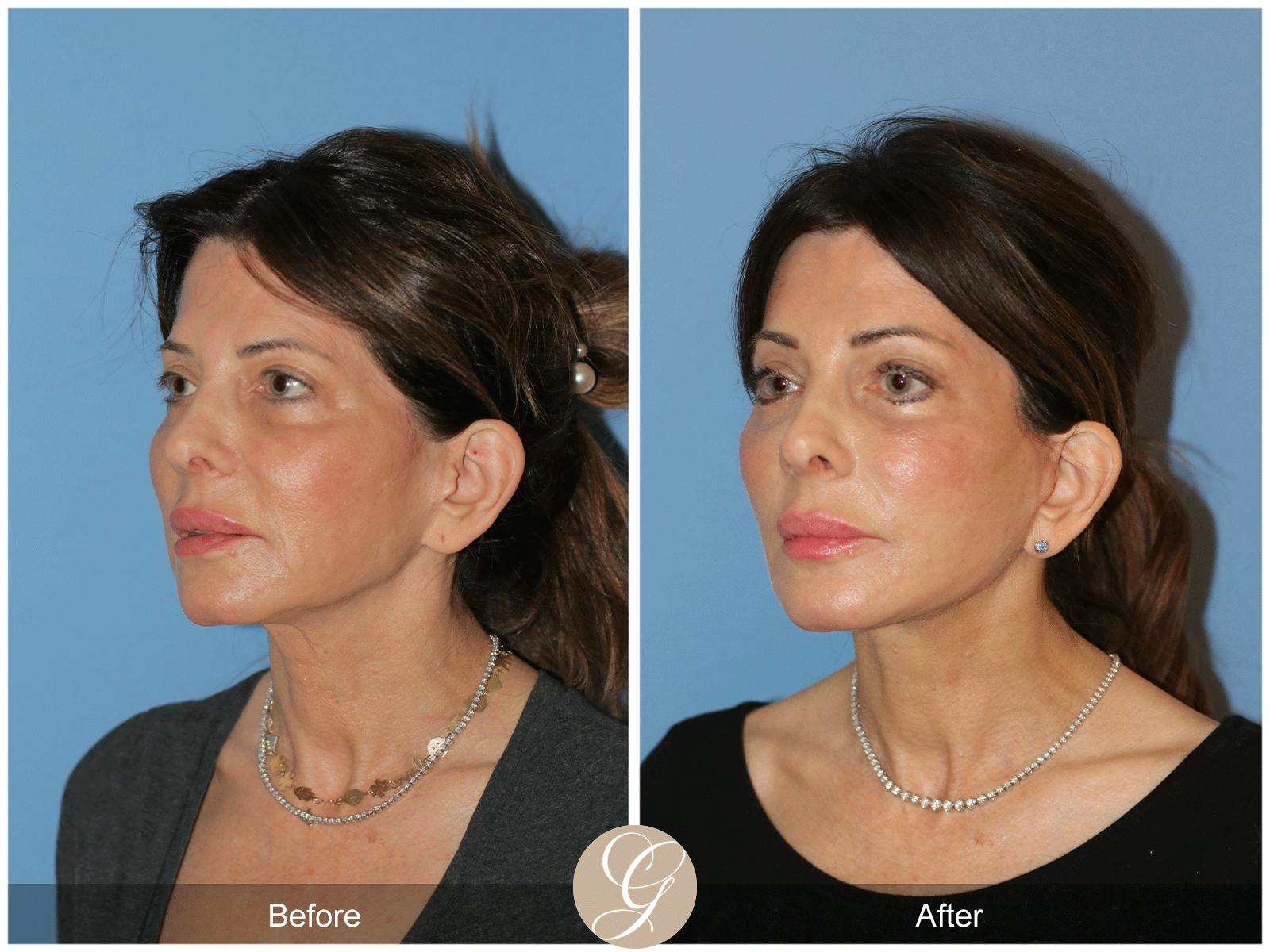 Deep Plane Facelift Before & After Gallery - Patient 364158 - Image 6