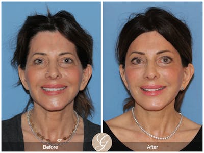 Preservation Facelift Before & After Gallery - Patient 159068 - Image 1
