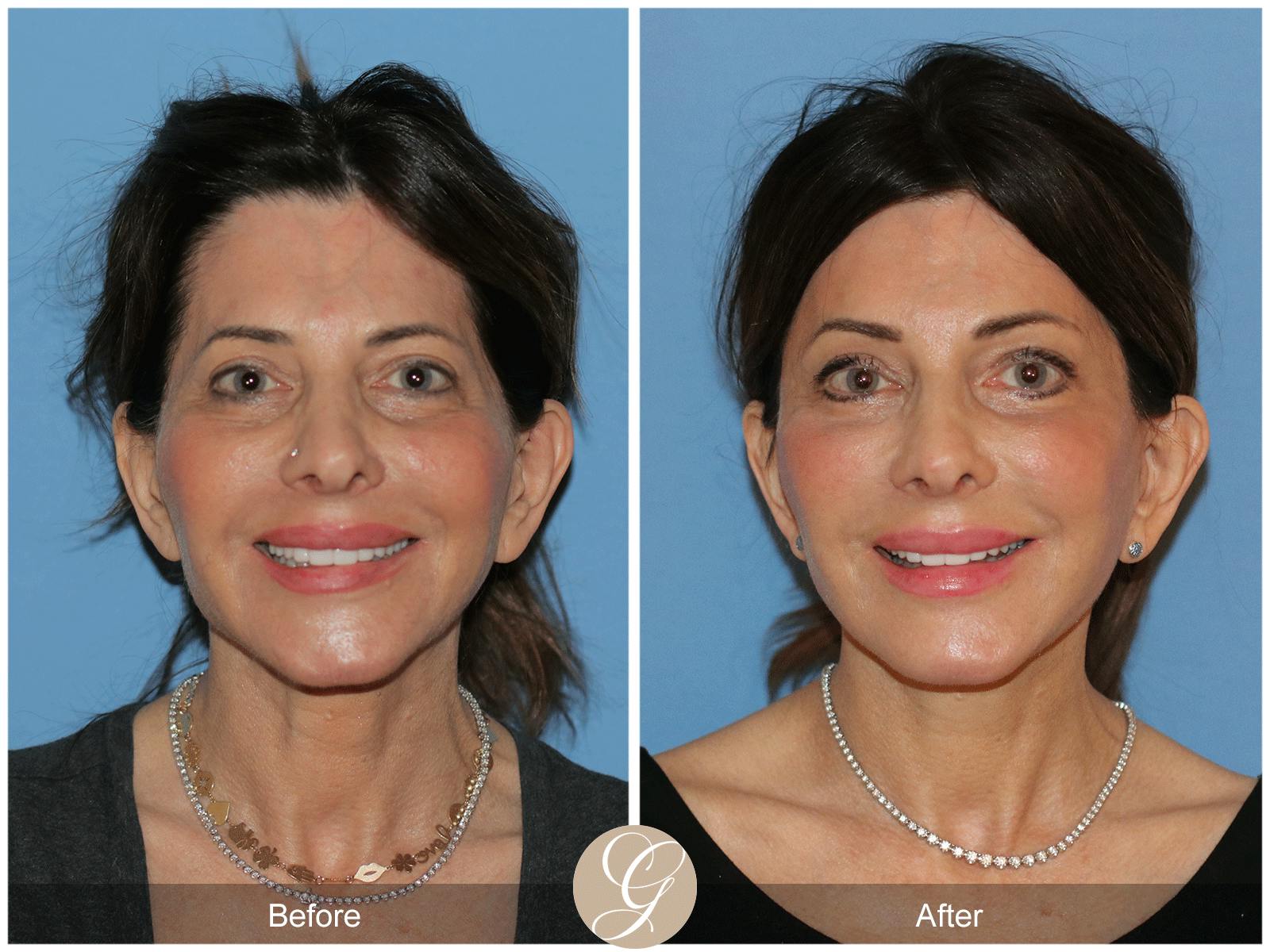 Deep Plane Facelift Before & After Gallery - Patient 364158 - Image 1