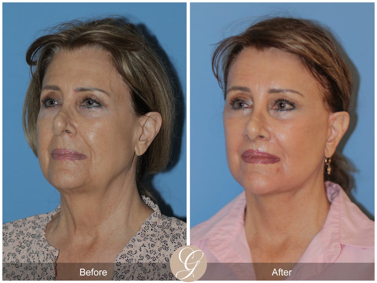 Neck Lift Before & After Gallery - Patient 315991 - Image 3