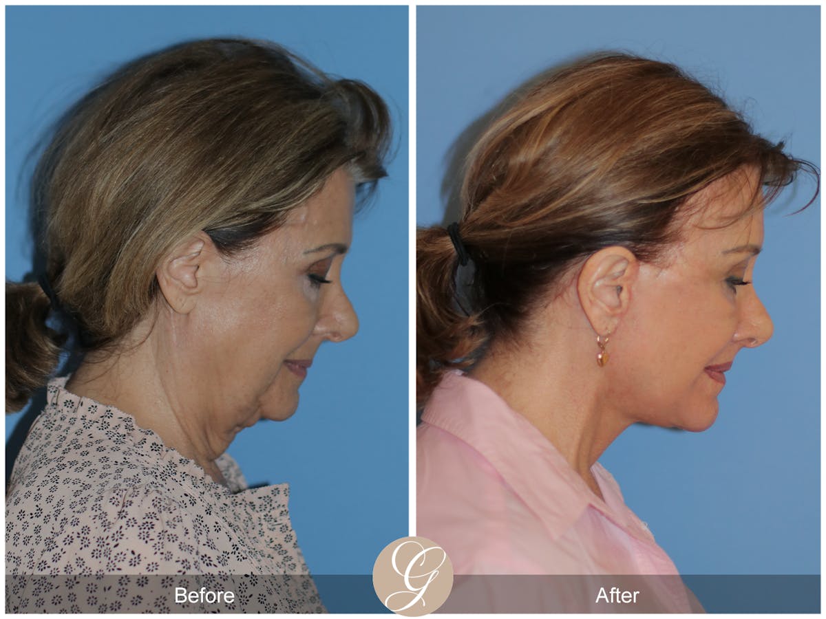 Neck Lift Before & After Gallery - Patient 315991 - Image 5