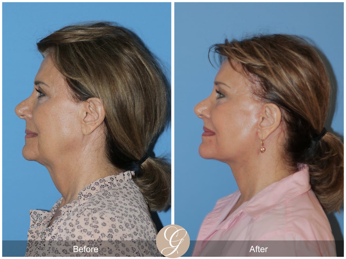 Neck Lift Before & After Gallery - Patient 315991 - Image 1