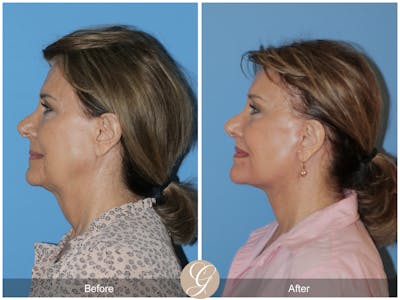Neck Lift Before & After Gallery - Patient 315991 - Image 1