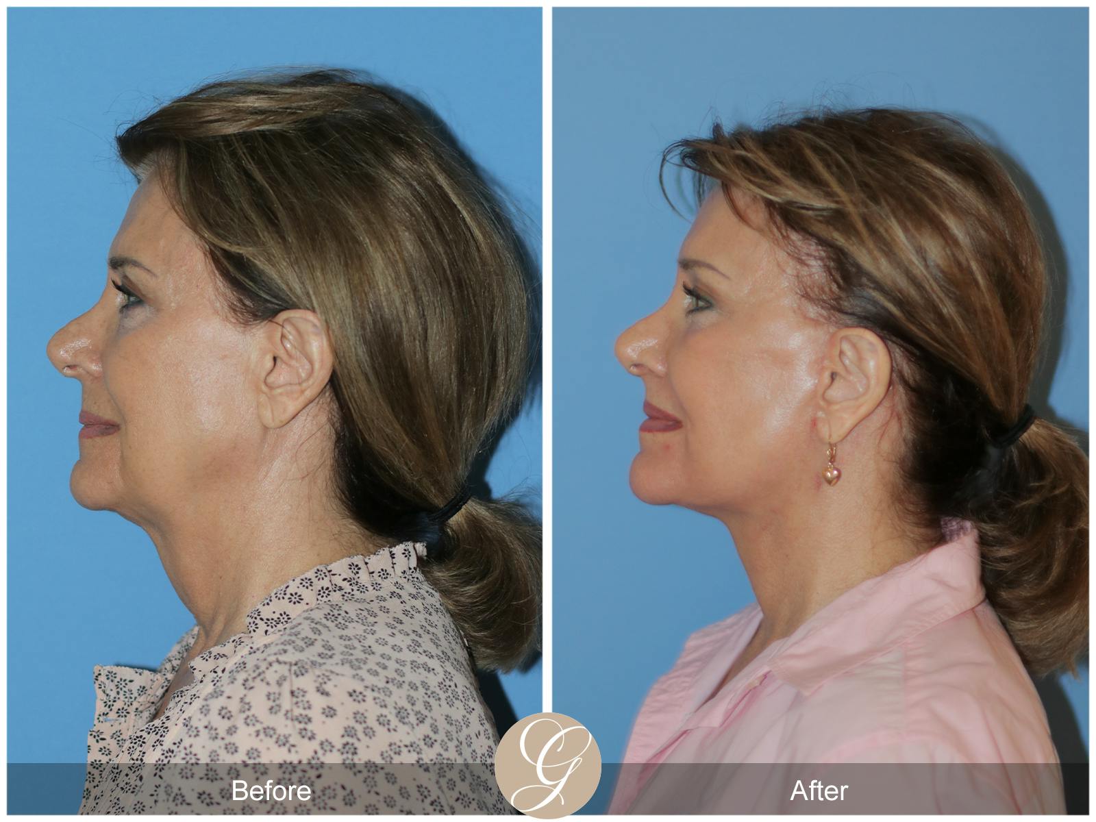Neck Lift Before & After Gallery - Patient 315991 - Image 1
