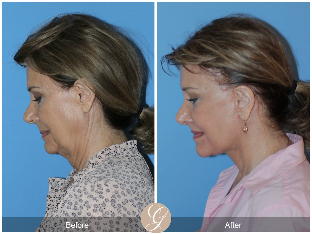 Neck Lift Before & After Gallery - Patient 315991 - Image 2