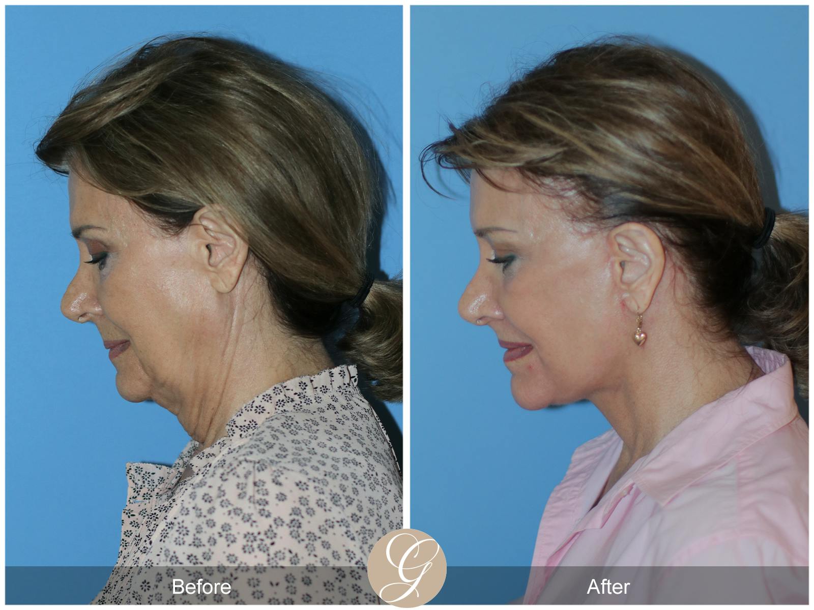 Neck Lift Before & After Gallery - Patient 315991 - Image 2